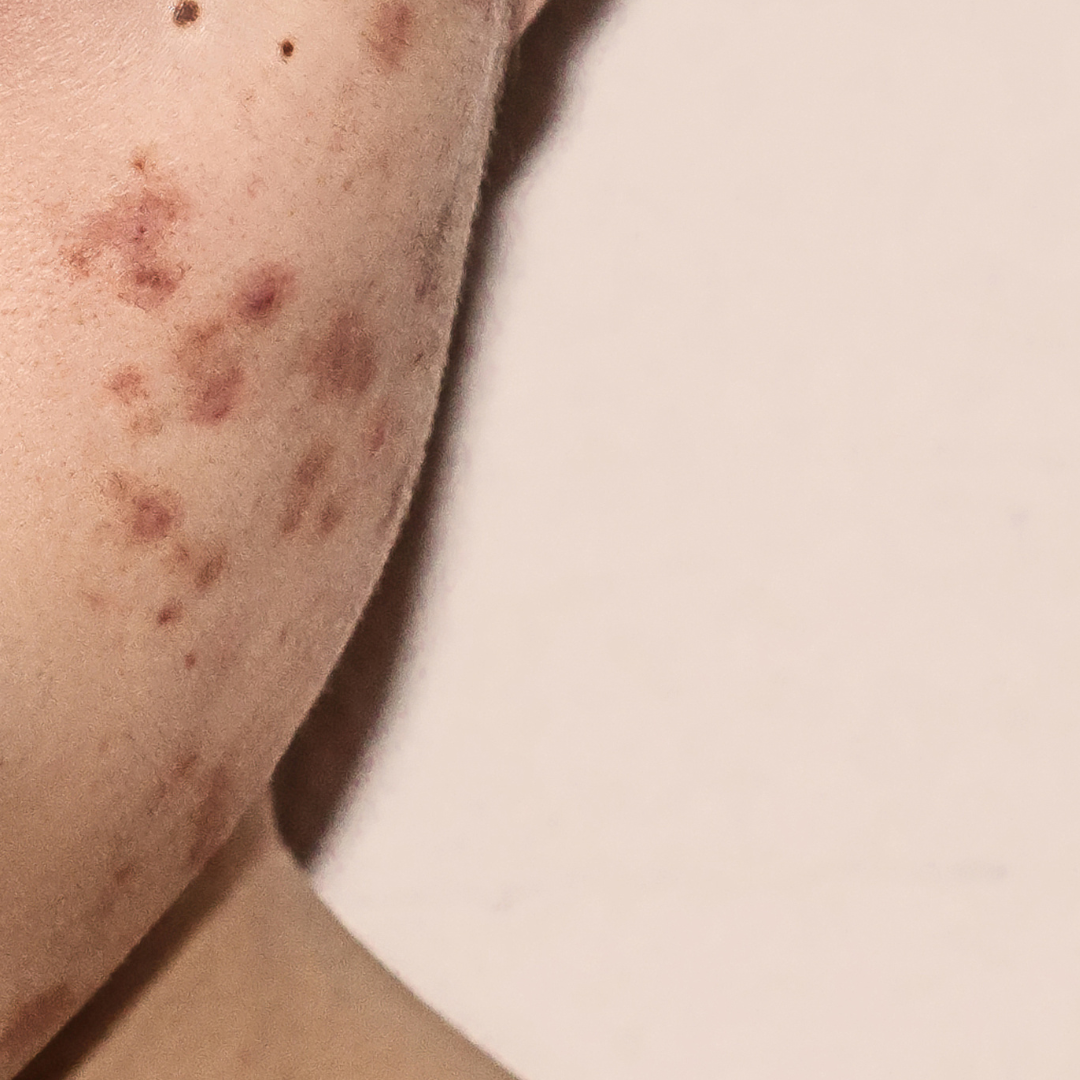 Close-up of acne-affected facial skin