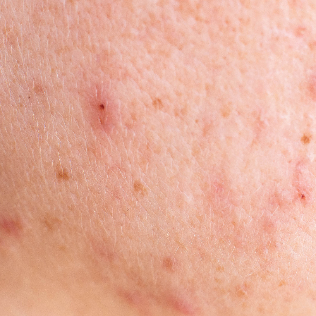 Close-up of skin showing inflammatory marks and blemishes associated with acne-related microbiome imbalance